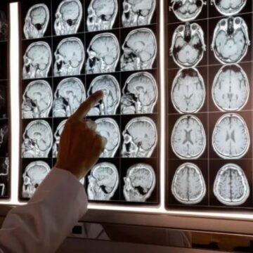 Día Mundial del Ataque Cerebral: todo lo que hay que saber